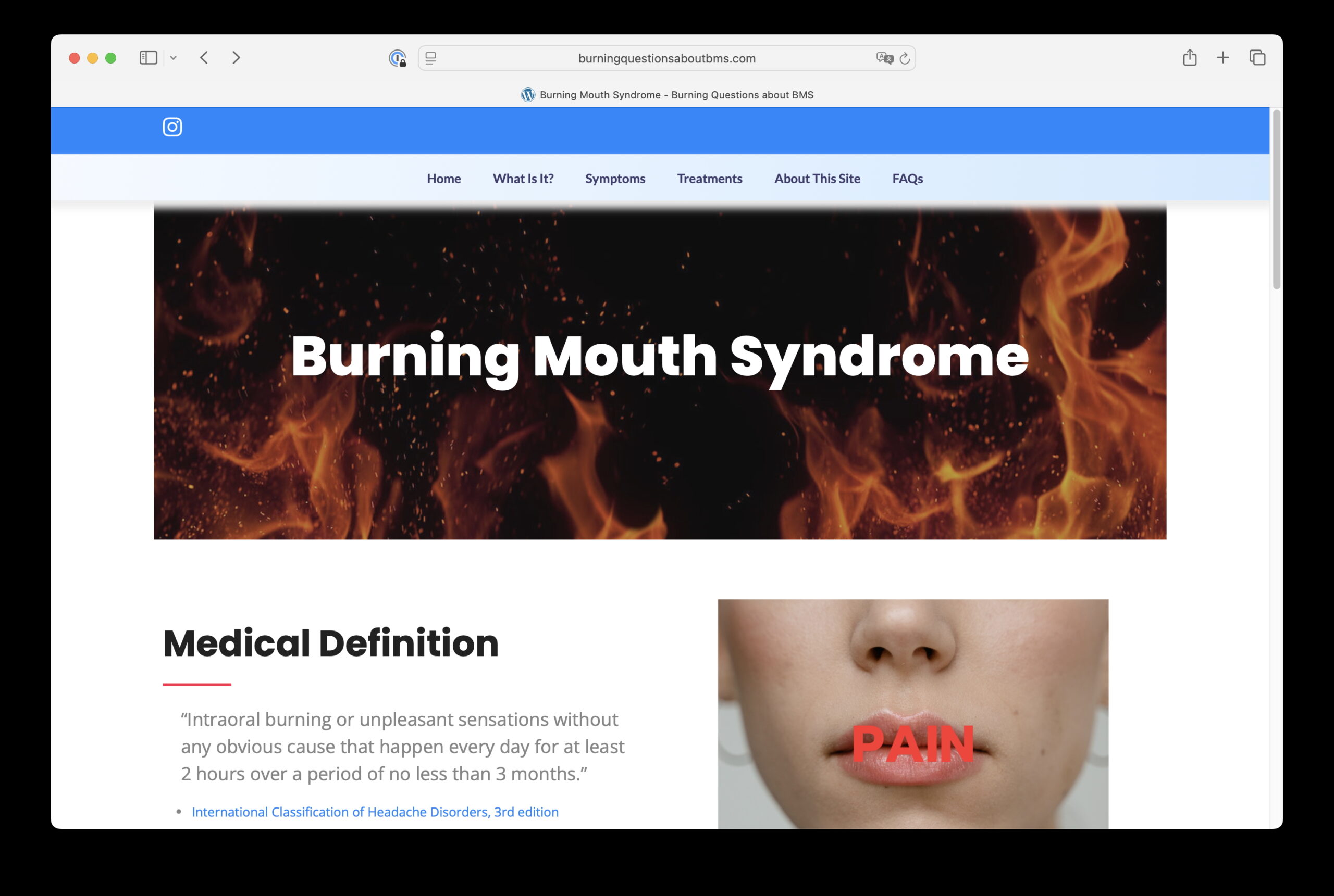 Burning Mouth Syndrome